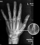 Neues von Onkel Röntgen: diesmal Pute`s Hand